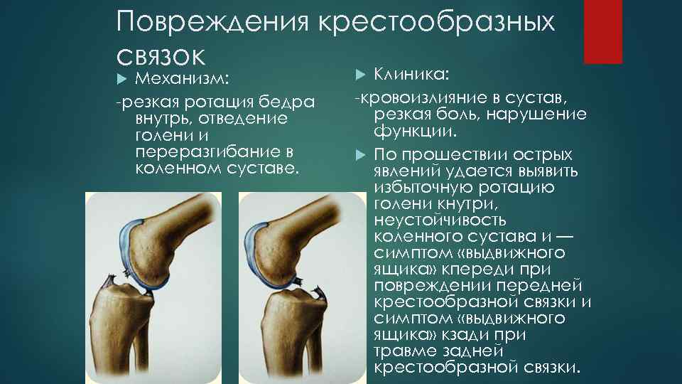 Повреждения крестообразных связок Механизм: резкая ротация бедра внутрь, отведение голени и переразгибание в коленном