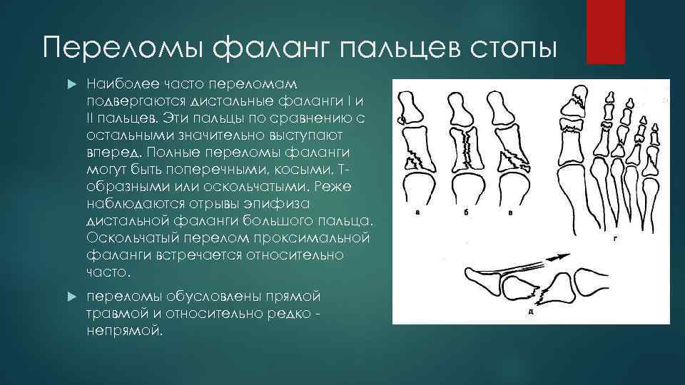 Переломы фаланг пальцев стопы Наиболее часто переломам подвергаются дистальные фаланги I и II пальцев.