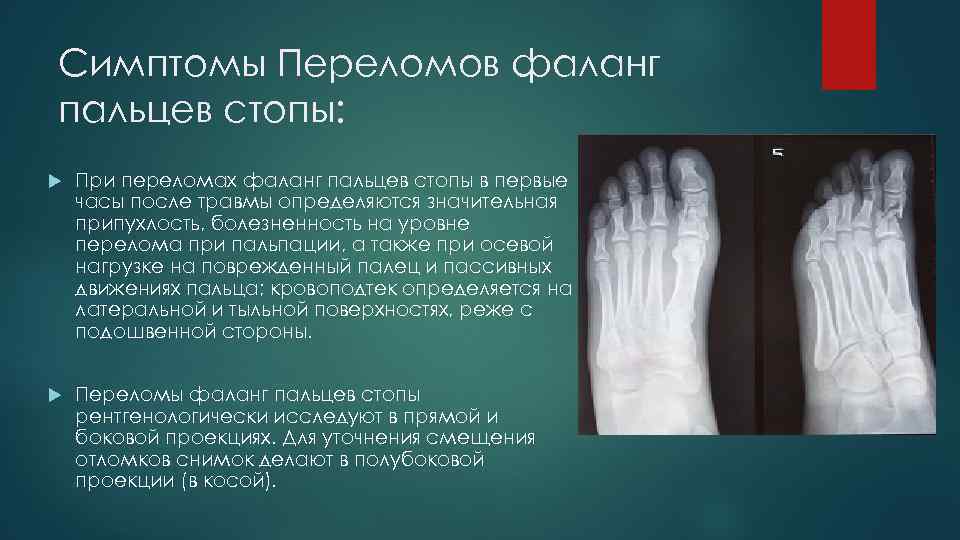 Симптомы Переломов фаланг пальцев стопы: При переломах фаланг пальцев стопы в первые часы после