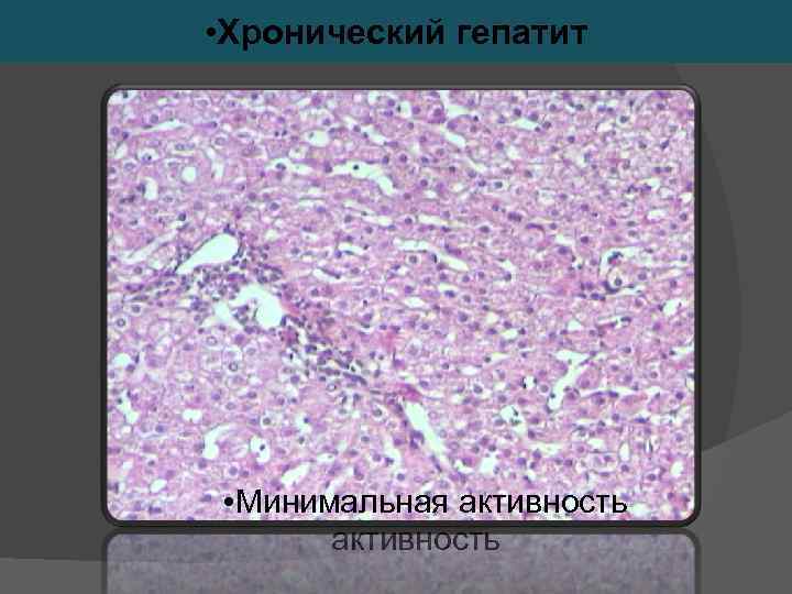  • Хронический гепатит • Умеренная активность • Слабовыраженная • Минимальная активность 
