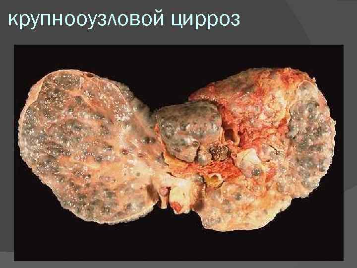 крупнооузловой цирроз 