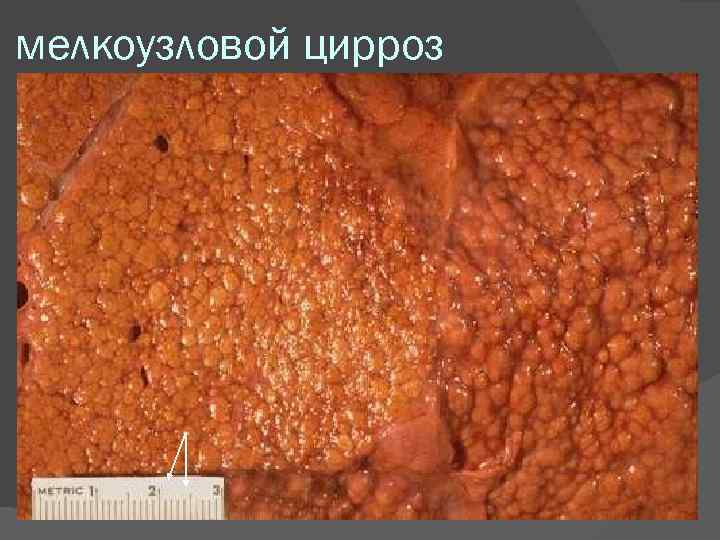 мелкоузловой цирроз 