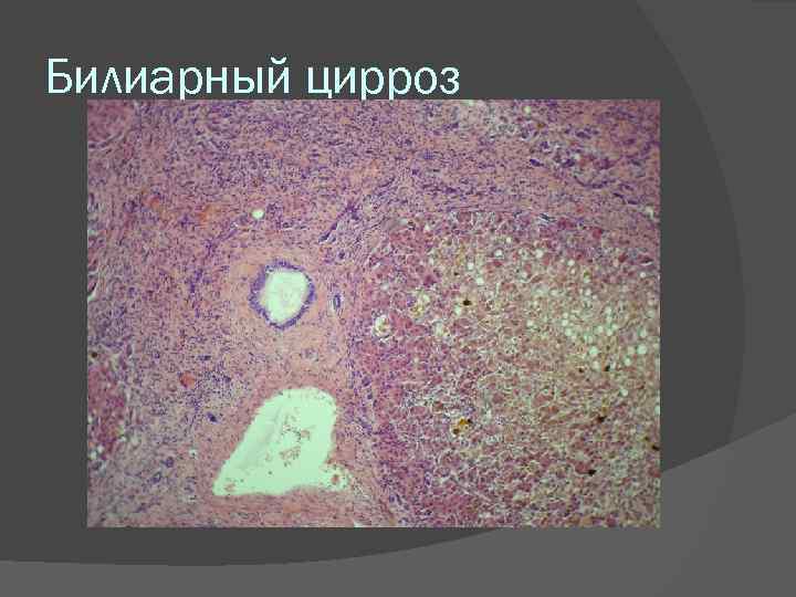 Билиарный цирроз 