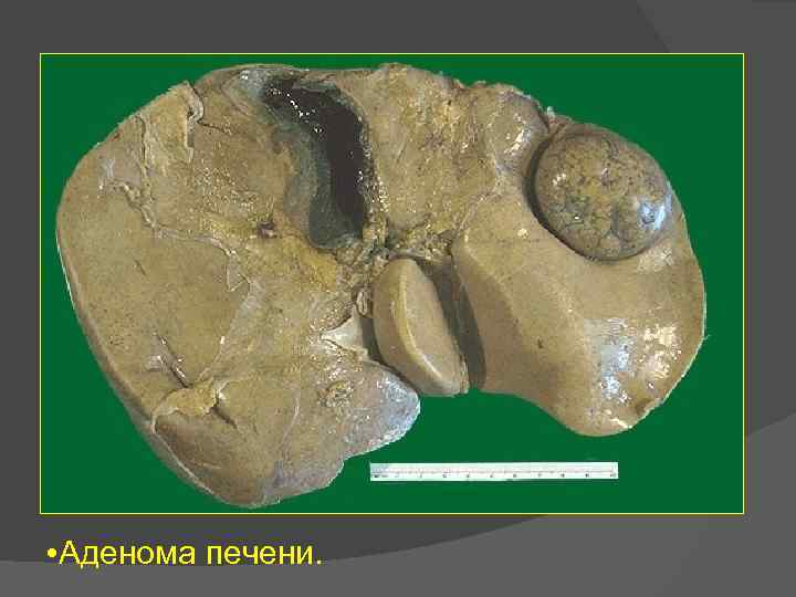  • Аденома печени. 