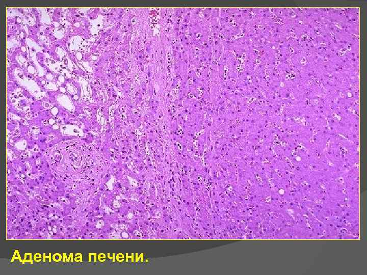 Аденома печени. 