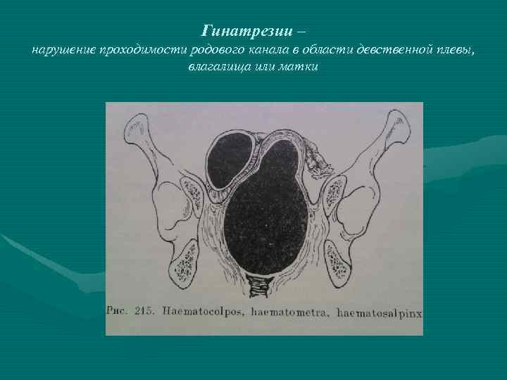 Гинатрезии – нарушение проходимости родового канала в области девственной плевы, влагалища или матки 