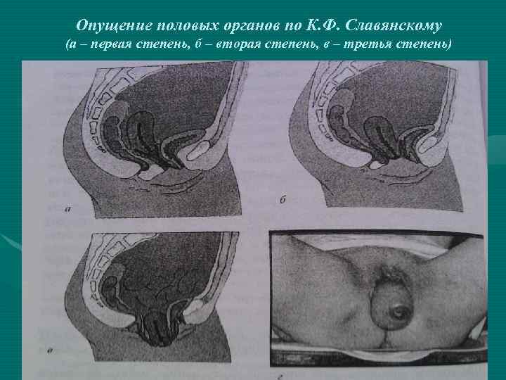 Опущение половых органов по К. Ф. Славянскому (а – первая степень, б – вторая