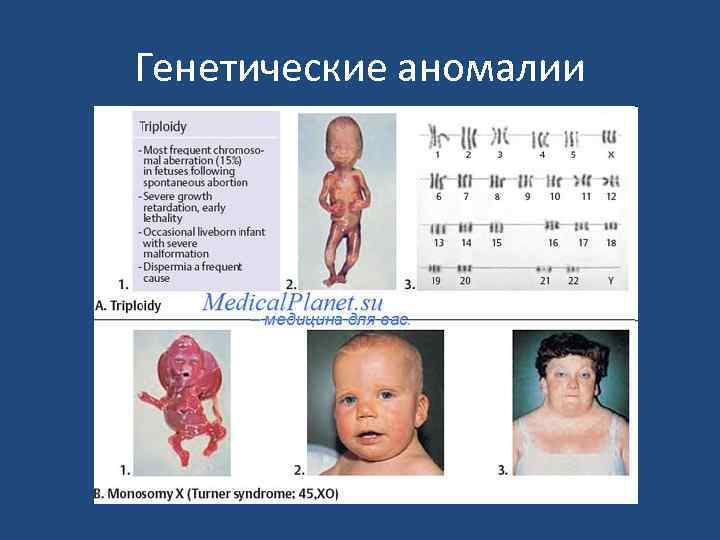 Генетические аномалии 