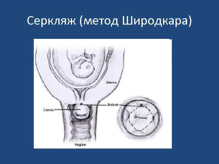 Серкляж (метод Широдкара) 