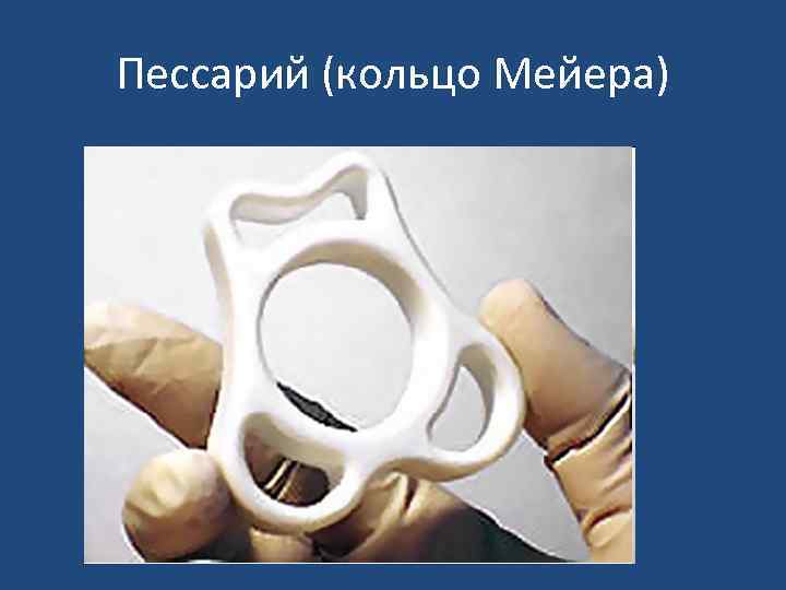 Пессарий (кольцо Мейера) 