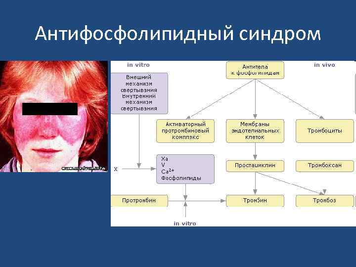 Антифосфолипидный синдром 