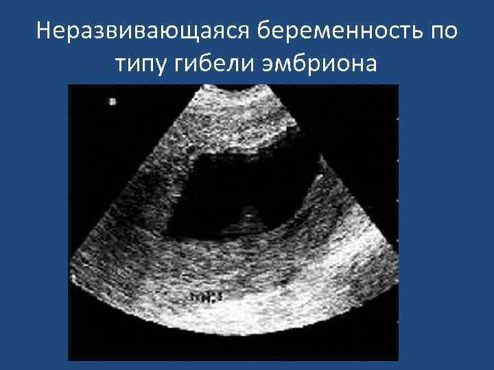 Неразвивающаяся беременность по типу гибели эмбриона 