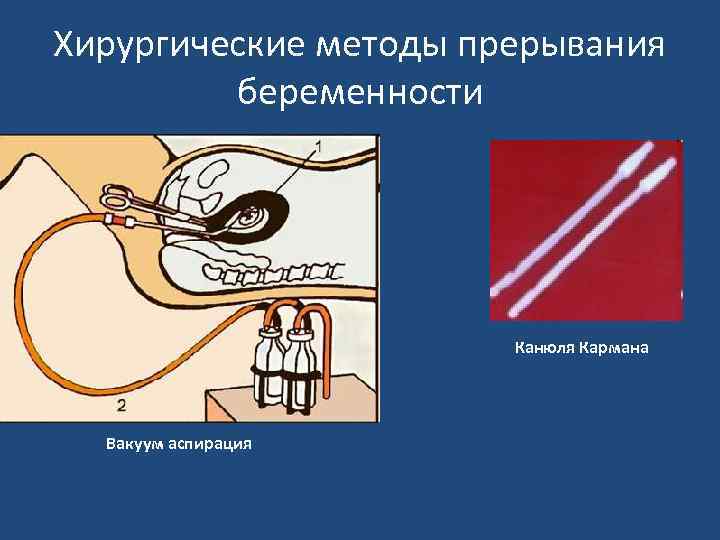 Хирургические методы прерывания беременности Канюля Кармана Вакуум аспирация 