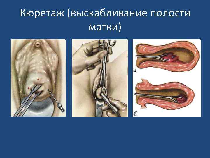 Кюретаж (выскабливание полости матки) 