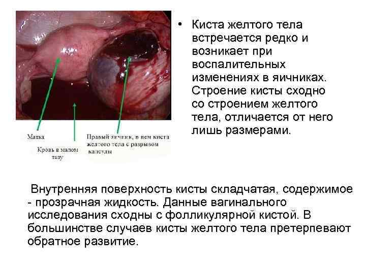  • Киста желтого тела встречается редко и возникает при воспалительных изменениях в яичниках.