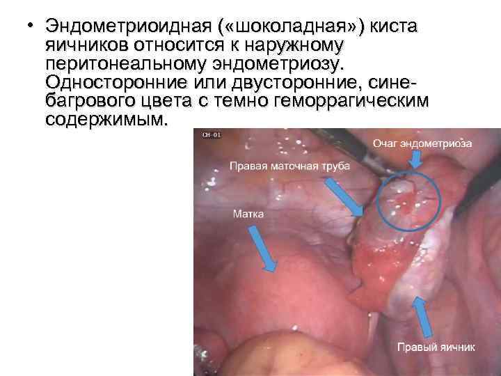  • Эндометриоидная ( «шоколадная» ) киста яичников относится к наружному перитонеальному эндометриозу. Односторонние