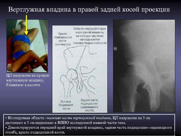 Вертлужная впадина в правой задней косой проекции ЦЛ направлен на правую вертлужную впадину, ближнюю