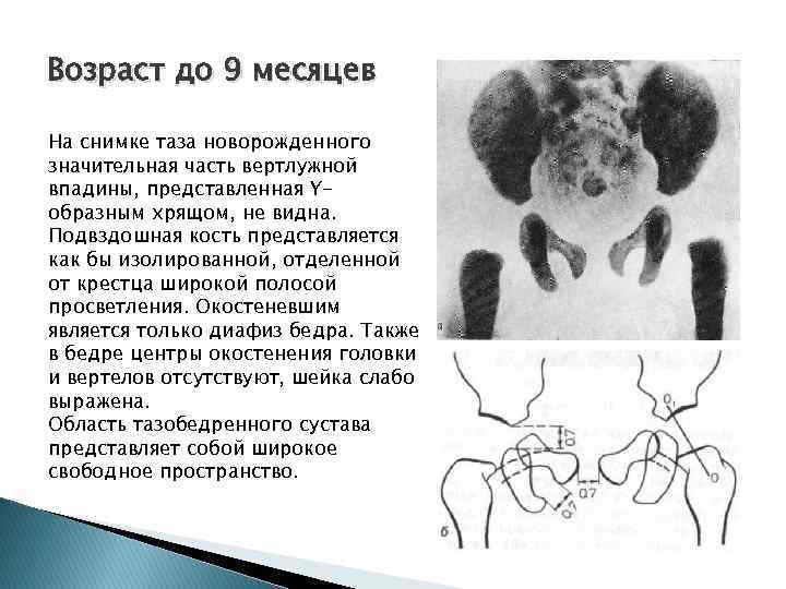 Возраст до 9 месяцев На снимке таза новорожденного значительная часть вертлужной впадины, представленная Yобразным