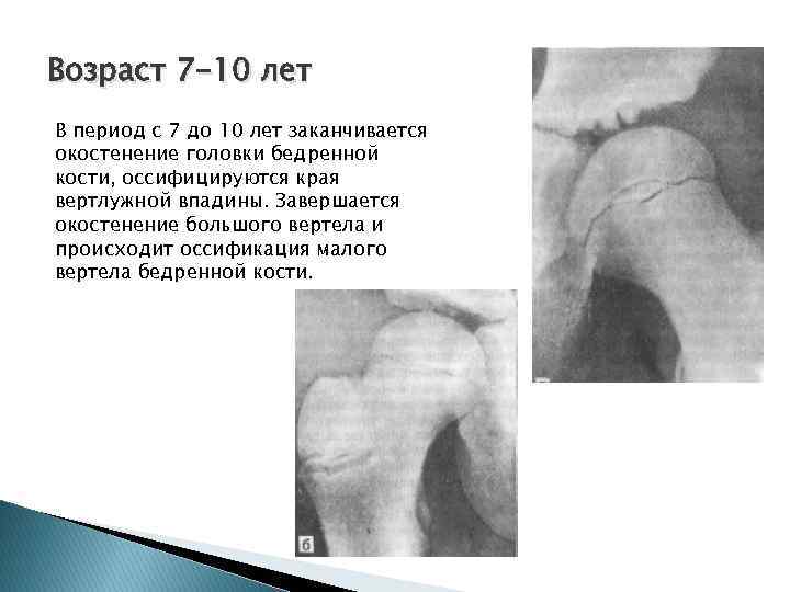 Возраст 7 -10 лет В период с 7 до 10 лет заканчивается окостенение головки