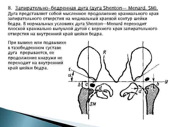 Схема Рейнберга врожденный вывих бедра. Схема Омбредана. Рентгеноанатомия тазобедренного сустава.