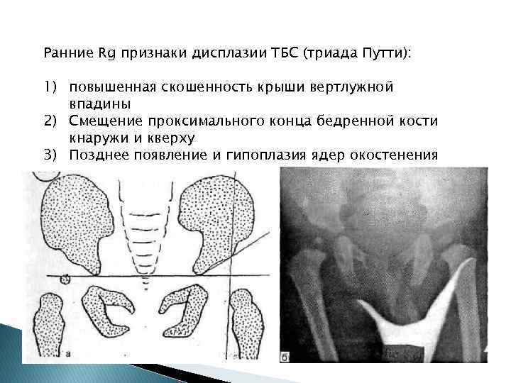 Ранние Rg признаки дисплазии ТБС (триада Путти): 1) повышенная скошенность крыши вертлужной впадины 2)