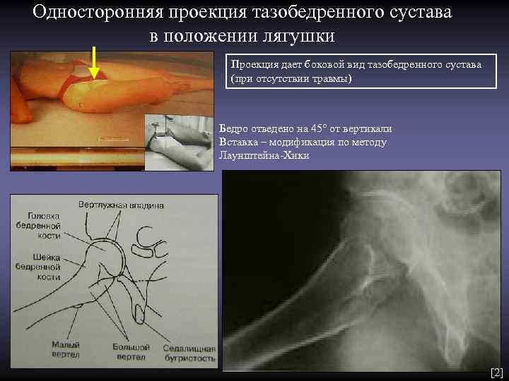 Односторонняя проекция тазобедренного сустава в положении лягушки Проекция дает боковой вид тазобедренного сустава (при