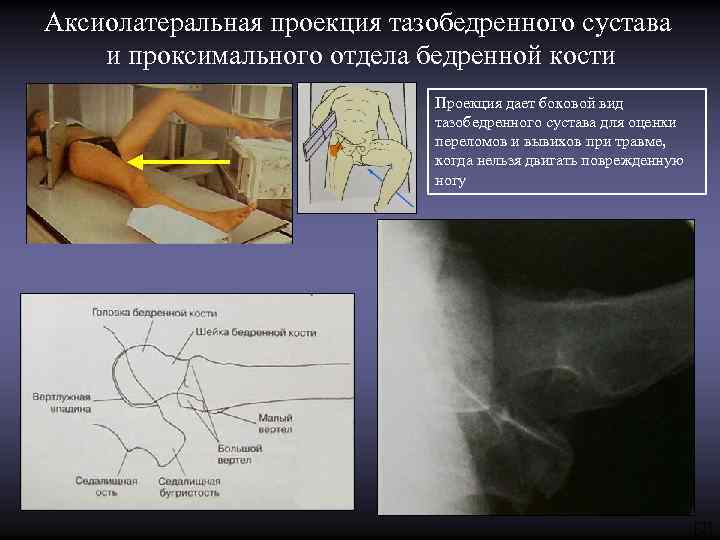 Аксиолатеральная проекция тазобедренного сустава и проксимального отдела бедренной кости Проекция дает боковой вид тазобедренного