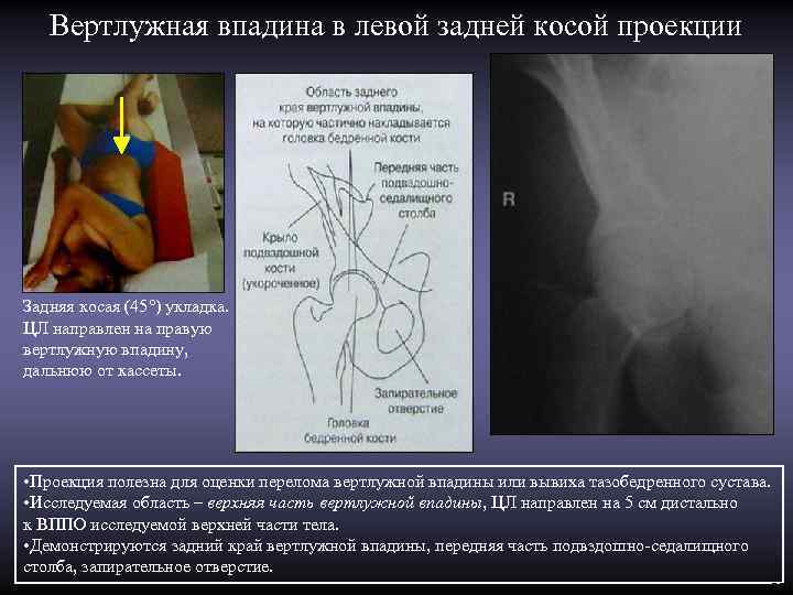 Вертлужная впадина в левой задней косой проекции Задняя косая (45°) укладка. ЦЛ направлен на