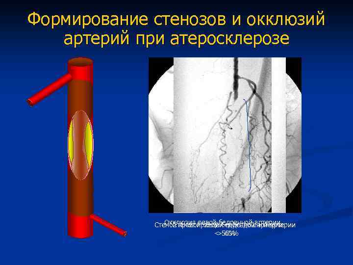 Окклюзия сосудов нижних