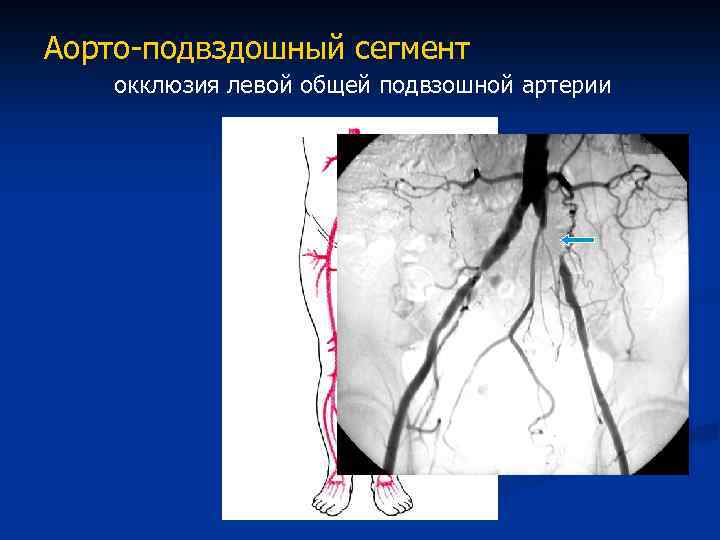 Окклюзия бедренной