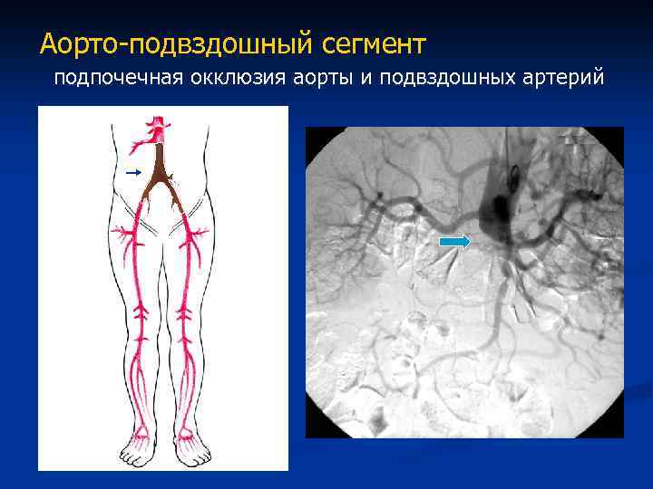 Тромбоз артерий нижних конечностей