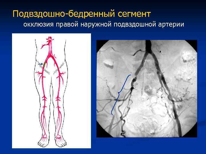 Тромбоз вен таза. Тромбоз бедренной артерии ангиография. Атеросклероз бедренной артерии рентген. Облитерирующий атеросклероз сосудов ног. Облитерирующий атеросклероз бедренной артерии.