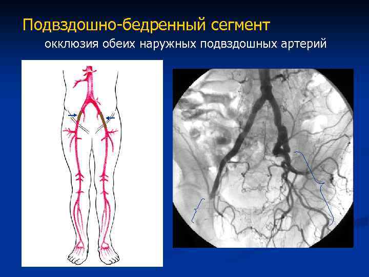 Тромбоз подвздошной вены. Подвздошно бедренная Вена. Подвздошная артерия. Подвздошная артерия нижних конечностей. Тромбоз подвздошной артерии.