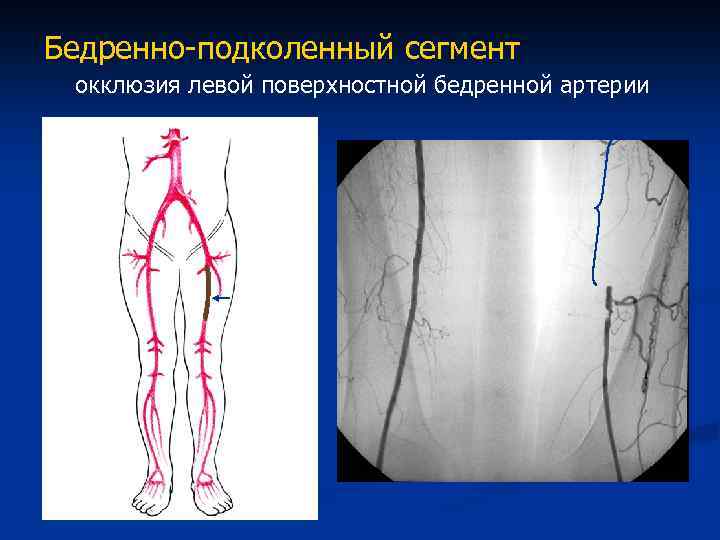 Артерия ноги операция. Облитерирующий атеросклероз бедренной артерии. Флеботромбоз бедренной артерии. Тромбэктомия артерий нижних конечностей. Облитерирующий атеросклероз сосудов нижних конечностей.