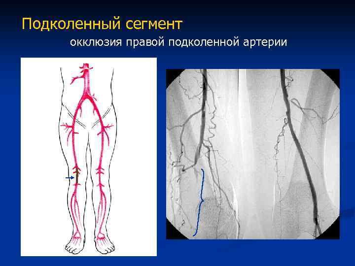 Бедренно подколенное окклюзии