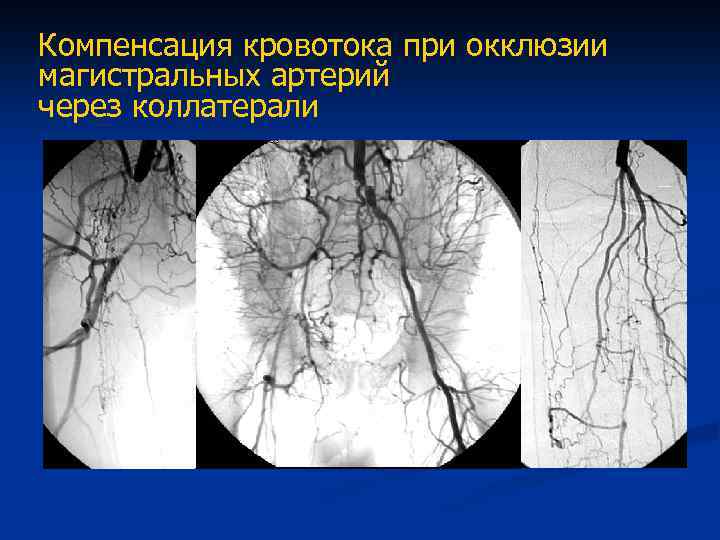 Окклюзия ноги. Окклюзия ПБА нижних конечностей. Окклюзия магистральных сосудов. Окклюзия магистральных артерий это.