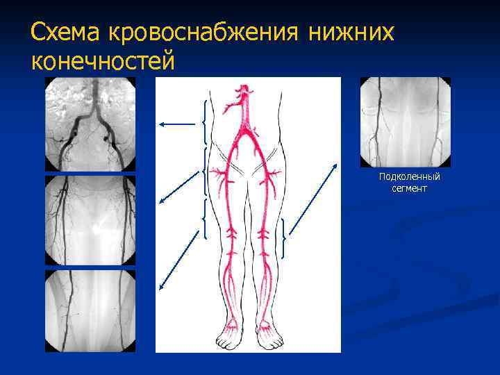 Бедренно подколенное окклюзии