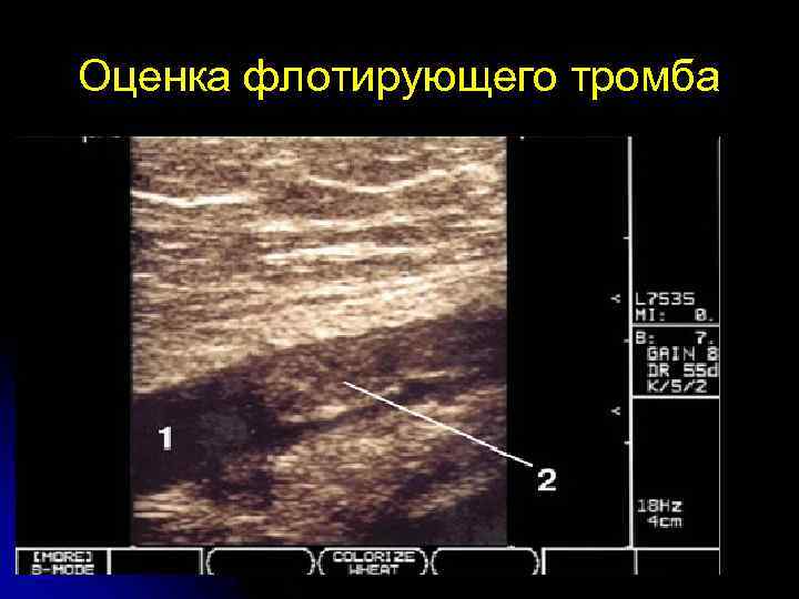 Узи тромбозов. Флотирующий тромб в бедренной Вене. Признаки флотирующего тромба УЗИ. Флотирующий тромбоз БПВ.