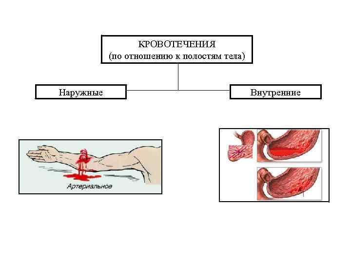 КРОВОТЕЧЕНИЯ (по отношению к полостям тела) Наружные Внутренние 
