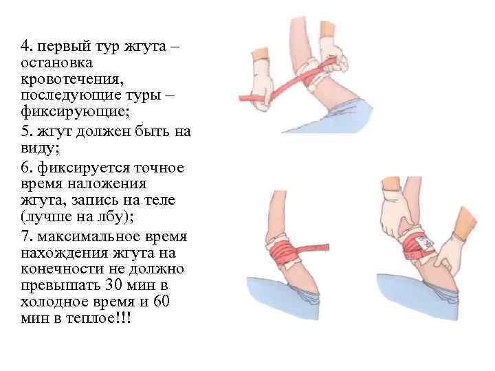 Рассмотрите изображение и определите какая ошибка совершена в данном случае при наложении жгута