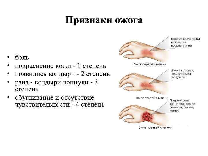 Признаки ожога • • боль покраснение кожи - 1 степень появились волдыри - 2