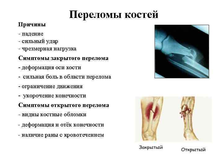 Переломы костей Причины - падение - сильный удар - чрезмерная нагрузка Симптомы закрытого перелома