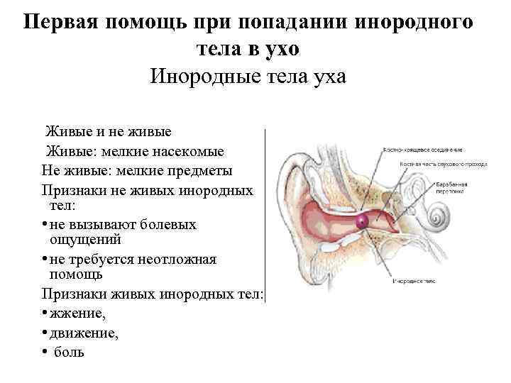 Первая помощь при попадании инородного тела в ухо Инородные тела уха Живые и не