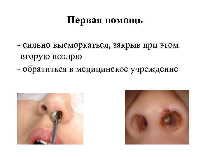 Первая помощь - сильно высморкаться, закрыв при этом вторую ноздрю - обратиться в медицинское