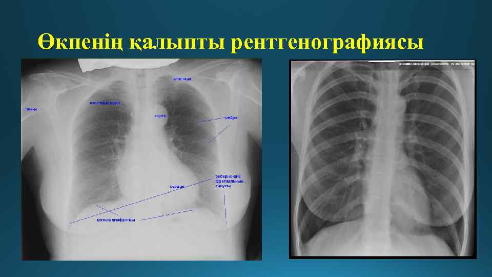 Өкпенің қалыпты рентгенографиясы 