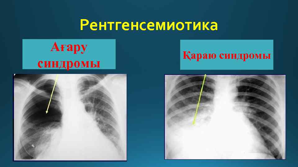 Рентгенсемиотика Ағару синдромы Қараю синдромы 