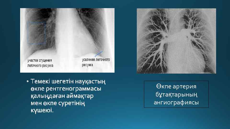 Өкпе артерия бұтақтарының ангиографиясы 