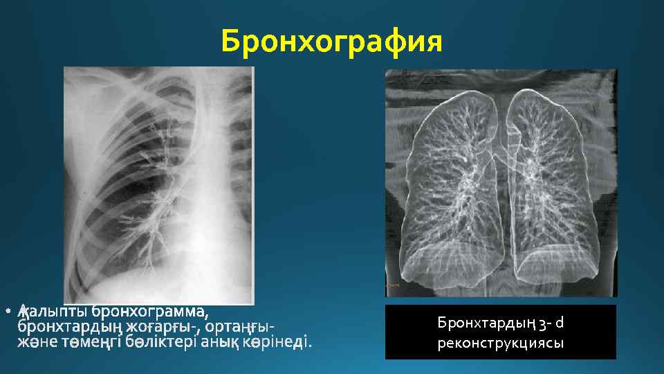 Бронхография Бронхтардың 3 - d реконструкциясы 