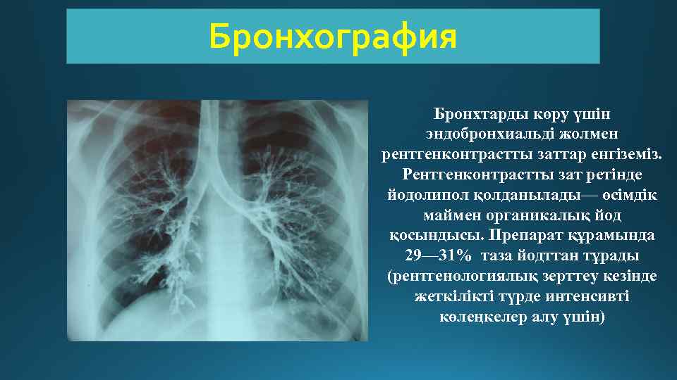 Бронхография Бронхтарды көру үшін эндобронхиальді жолмен рентгенконтрастты заттар енгіземіз. Рентгенконтрастты зат ретінде йодолипол қолданылады—