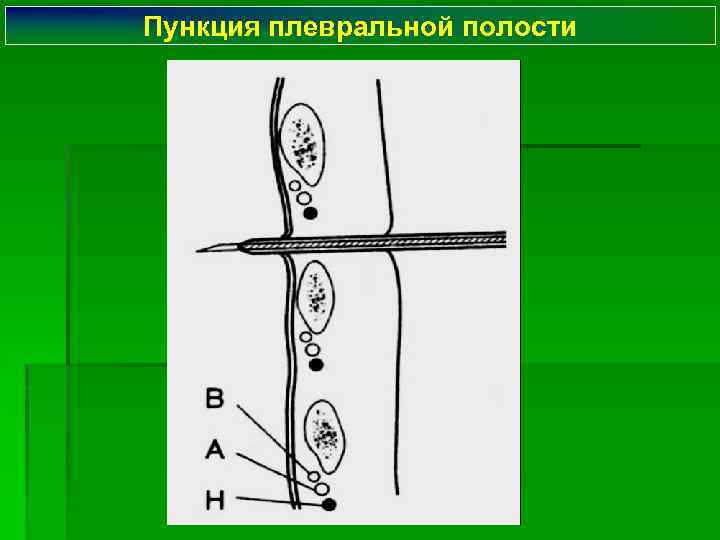Пункция плевральной полости 